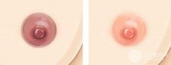 胸部美容怎样使乳晕变红