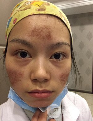 果酸换肤痘坑真实案例前后对比图分享