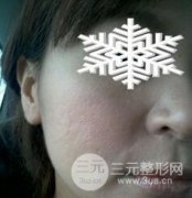 彩光嫩肤有用吗？真实案例前后对比图分享_全程实拍无美颜