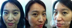 嫩肤去皱纹真实案例分享：消灭皱纹重返青春