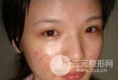 磨皮去痘坑前后对比图：告别痘坑从这一刻开始