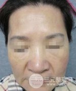 瑞蓝2号除皱果前后对比图:60岁的我还能返老还童! 瑞蓝2号除皱果前后对比图:60岁的我还能返老还童!