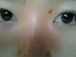 点痦子多少钱?果好不好?