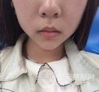 v型脸手术果亲身验证，下一个小脸美女就是你！
