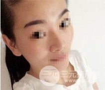 【鼻头+鼻小柱+鼻背】分段式假体隆鼻经验分享:**鼻子一样不可少 【鼻头+鼻小柱+鼻背】分段式假体隆鼻经验分享:**鼻子一样不可少
