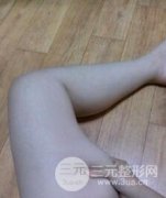 小腿部吸脂塑形：困扰我的肌肉小腿总算是瘦下去了！