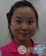 黑脸娃娃嫩肤术案例分享：变白的过程是先让自己变黑