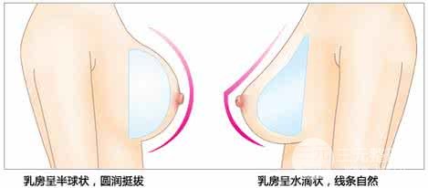 丰胸选择假体丰胸还是自体脂肪丰胸