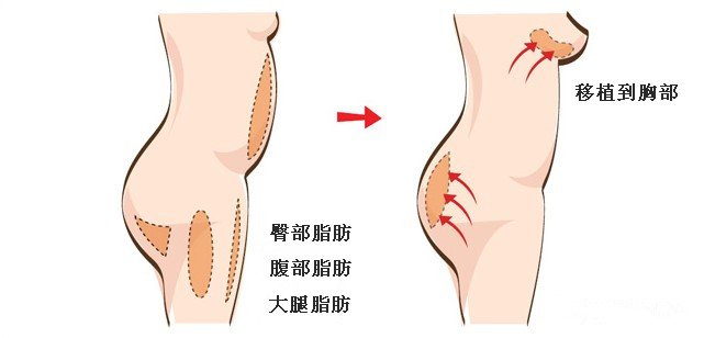 丰胸选择假体丰胸还是自体脂肪丰胸