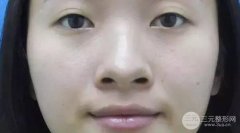 2017猪猪的隆鼻经验分享|前后对比图照片 2017猪猪的隆鼻经验分享|前后对比图照片