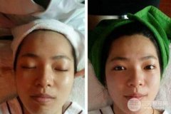 张富源徒手整形是真的吗？原理是什么？