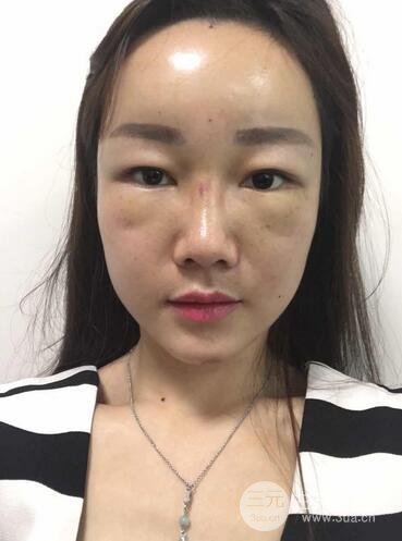自体脂肪填充后的照片 前后果对比--美联致美