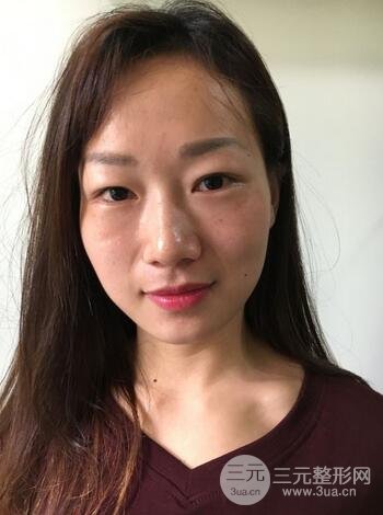 自体脂肪填充后的照片 前后果对比--美联致美