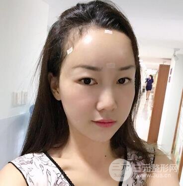 自体脂肪填充后的照片 前后果对比--美联致美