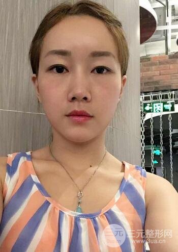 自体脂肪填充后的照片 前后果对比--美联致美
