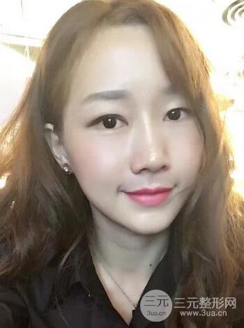 自体脂肪填充后的照片 前后果对比--美联致美