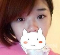 【膨体隆鼻+全切双眼皮】术后一个月恢复过程详情图
