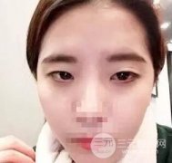 双眼皮手术真实案例，自带美瞳果的双眼皮连眼线都省了！