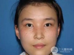脸部祛斑真实案例分享，“斑”花到班花竟然如此简单！