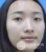全鼻再造术真实案例分享,让我美得360度无死角! 全鼻再造术真实案例分享,让我美得360度无死角!