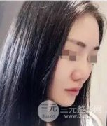 隆鼻整形三个月恢复记录分享,平凡妹纸进军女神行列! 隆鼻整形三个月恢复记录分享,平凡妹纸进军女神行列!