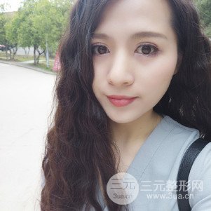 切开双眼皮前后对比图 美联致美切开双眼皮恢复过程