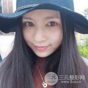 切开双眼皮前后对比图 美联致美切开双眼皮恢复过程