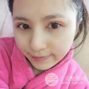 切开双眼皮前后对比图 美联致美切开双眼皮恢复过程
