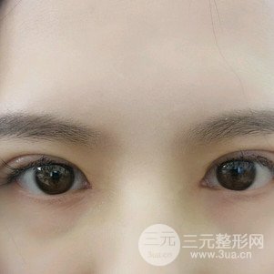 切开双眼皮前后对比图 美联致美切开双眼皮恢复过程