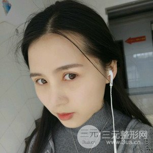 切开双眼皮前后对比图 美联致美切开双眼皮恢复过程