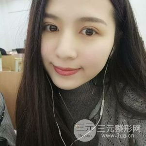 切开双眼皮前后对比图 美联致美切开双眼皮恢复过程