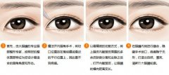 开内眼角后遗症|开内眼角前后对比照片