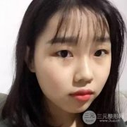做完双眼皮手术，清纯妹纸秒变气质女神！
