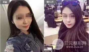 B****打几次定型