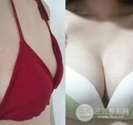 胸部大小不一样怎么办?隆胸真实案例诠释如何解决胸部大小不一! 胸部大小不一样怎么办?隆胸真实案例诠释如何解决胸部大小不一!