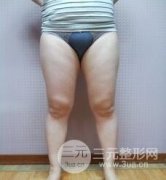 吸脂塑身手术真实案例分享：瘦大腿+瘦肚子摇身变苗条女神！