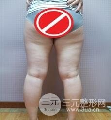 吸脂塑身手术