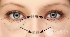 两张图让你知道卧蚕和眼袋的区别，附赠去眼袋丰卧蚕前后果图