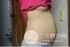 腹壁整形多少钱