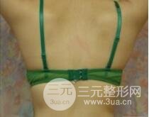 腹壁整形多少钱