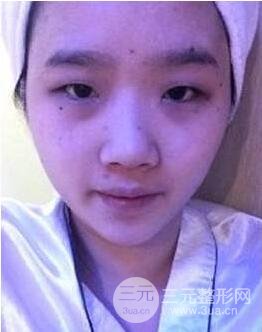 双眼皮手术