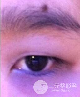 双眼皮手术