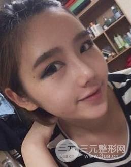 隆鼻术