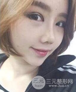 隆鼻术