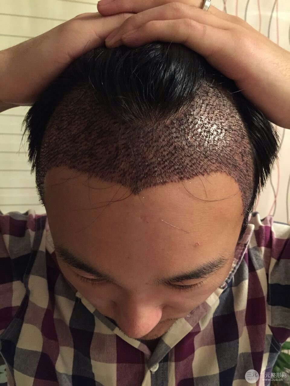 形象要求比较高,发际线太有影响了,因此在多方面的了解后选择了做植发