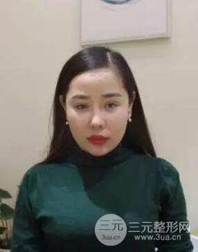 自体脂肪丰额头2