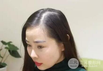 自体脂肪丰额头3