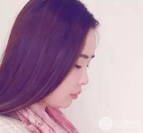 自体脂肪丰额头7