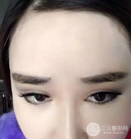 自体脂肪丰额头9