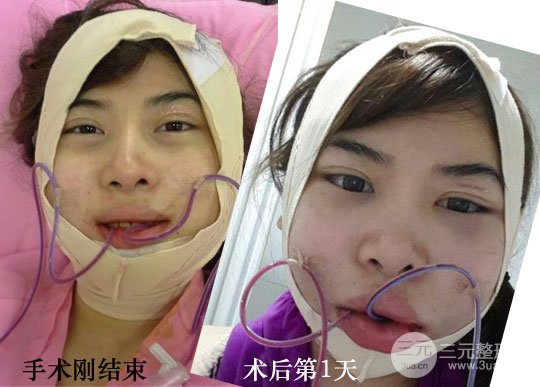 面部轮廓削骨整形术一个月恢复效果案例分享
